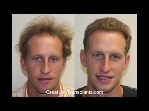 Hair Transplant Videos