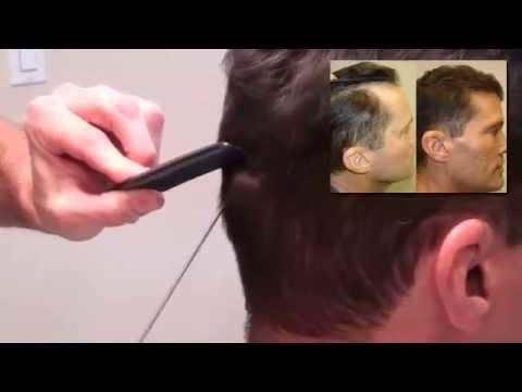 Hair Transplant Video