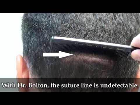 Hair Transplant Videos