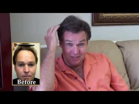 Hair Transplant Videos