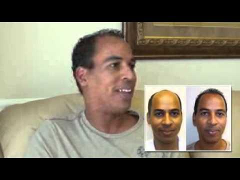 Hair Transplant Video