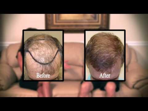 Hair Transplant Video