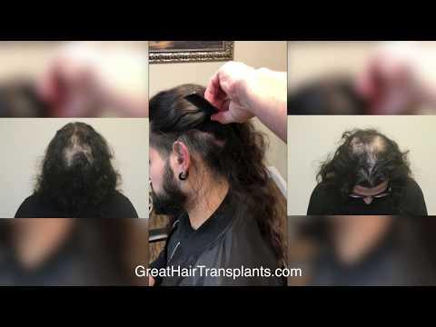 Hair Transplant Videos