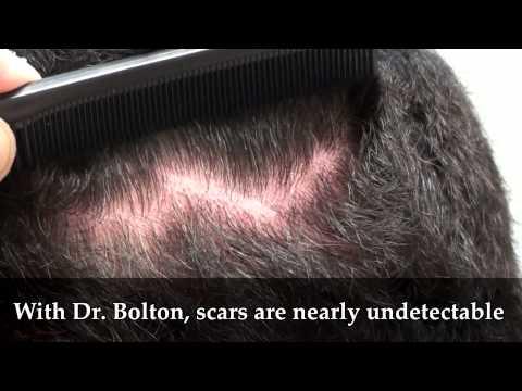 Hair Transplant Video