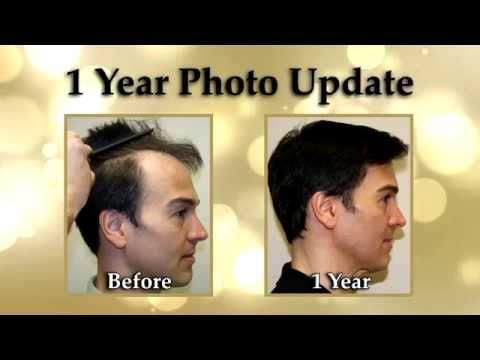 Hair Transplant Videos