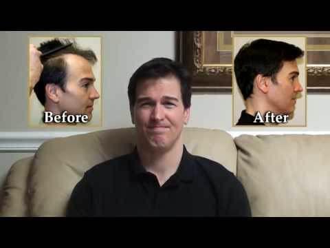 Hair Transplant Video