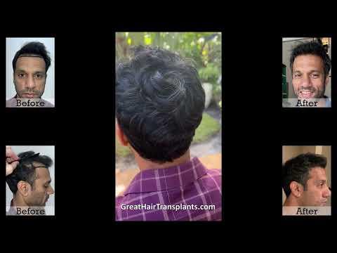 Hair Transplant Videos