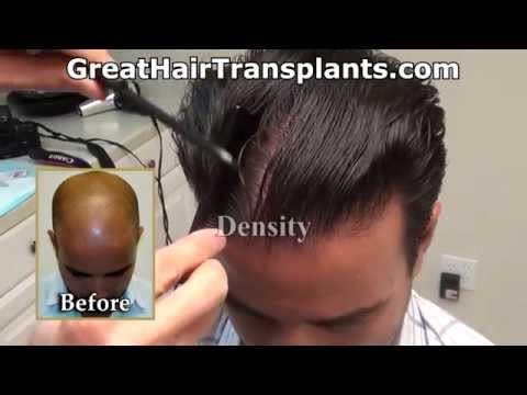 Hair Transplant Videos