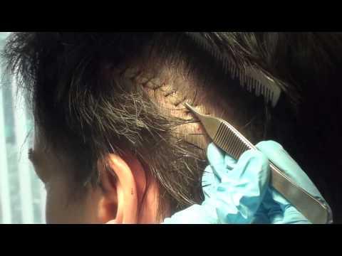 Hair Transplant Videos