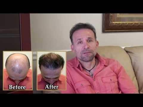 Hair Transplant Videos