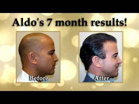 Hair Transplant Videos