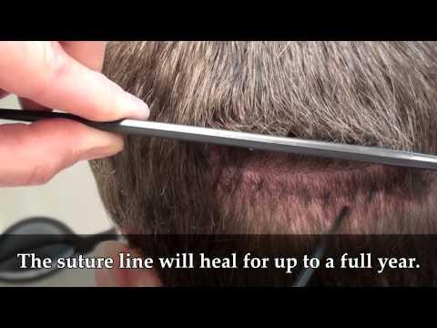 Hair Transplant Videos