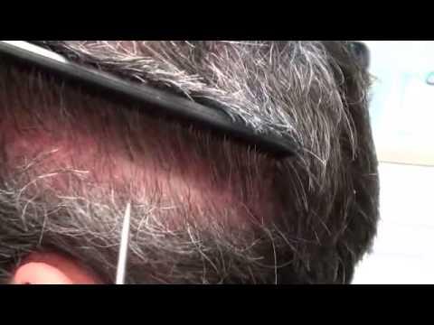 Hair Transplant Video