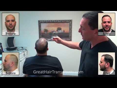 Hair Transplant Video