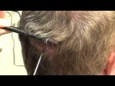 Hair Transplant Video