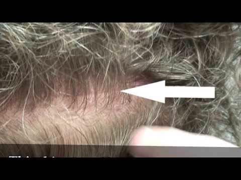 Hair Transplant Videos