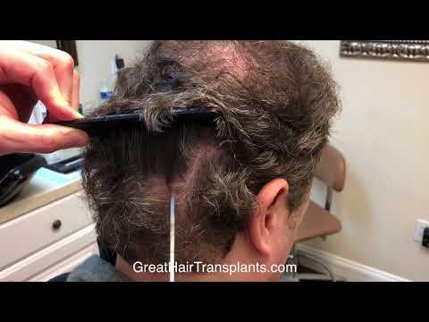 Hair Transplant Videos