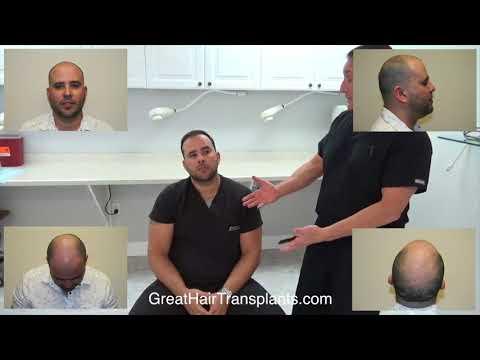 Hair Transplant Videos