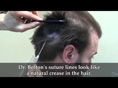 Hair Transplant Videos