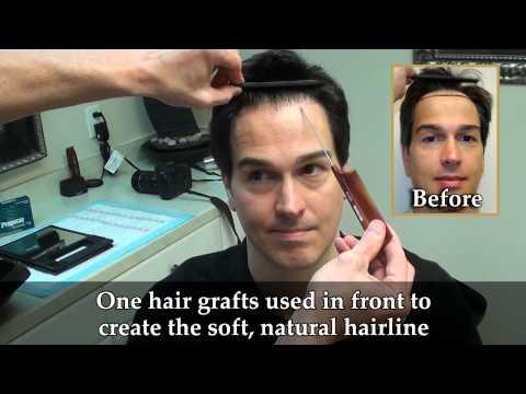 Hair Transplant Videos