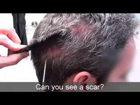 Hair Transplant Videos