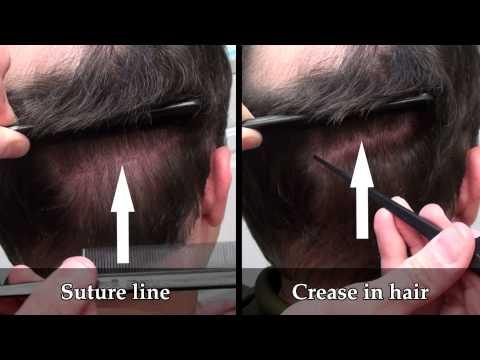 Hair Transplant Videos