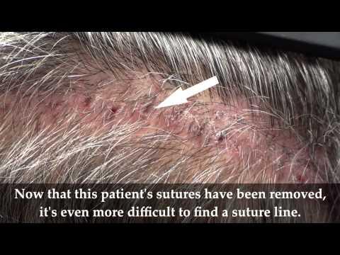 Hair Transplant Video