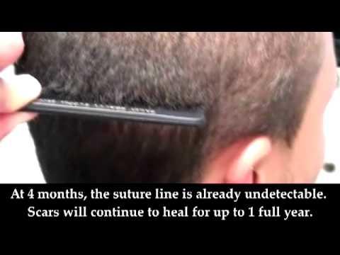 Hair Transplant Videos