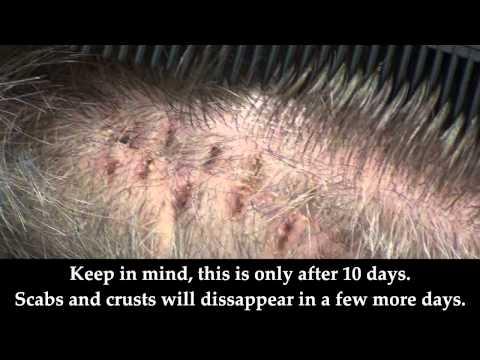 Hair Transplant Video