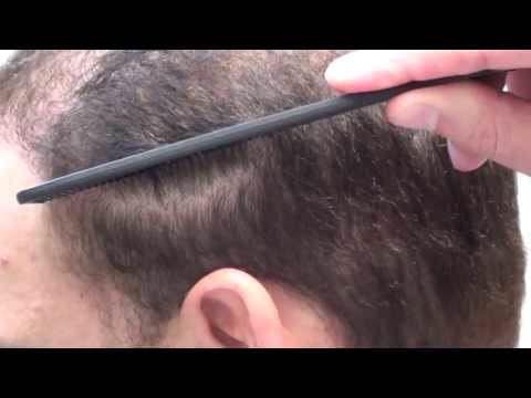 Hair Transplant Videos