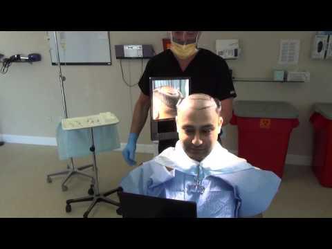 Hair Transplant Videos