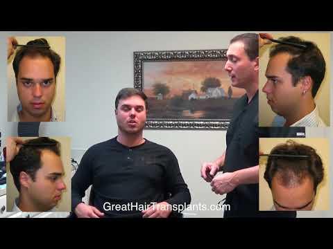 Hair Transplant Videos