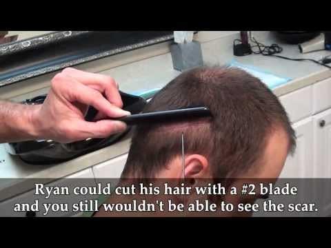 Hair Transplant Video