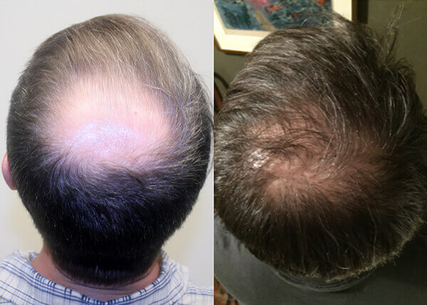 hair transplant Crown photos