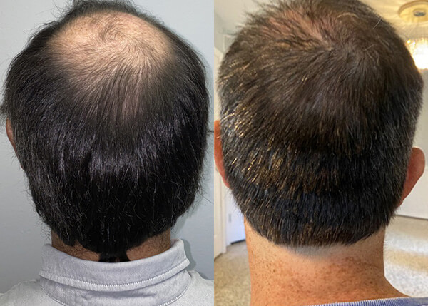 hair transplant Crown photos