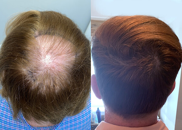 hair transplant Crown photos