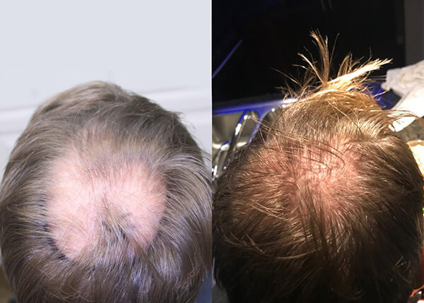 hair transplant Crown photos