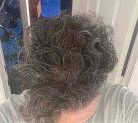 hair transplant photos