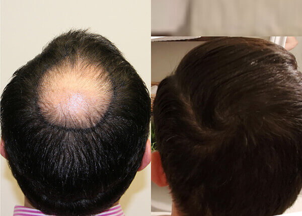 hair transplant Crown photos