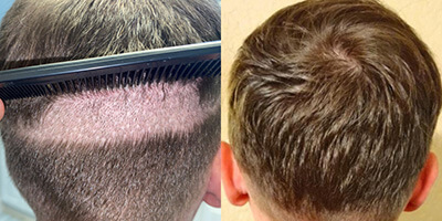 hair transplant photos