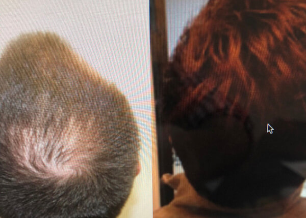hair transplant Crown photos