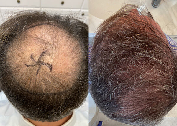 hair transplant Crown photos