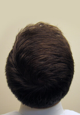 hair transplant photos