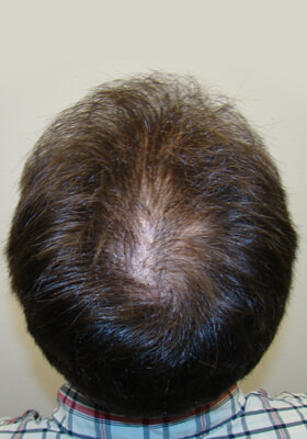 hair transplant photos