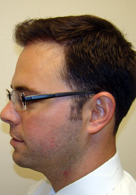 hair transplant photos