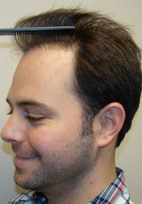 hair transplant photos