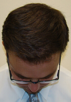 hair transplant photos