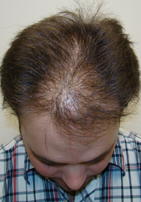 hair transplant before after Photos