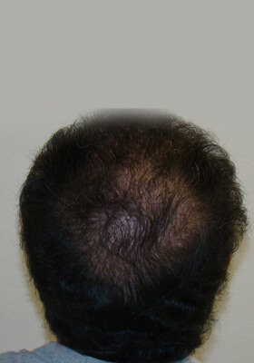 hair transplant before after Photos