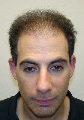 hair transplant before after Photos